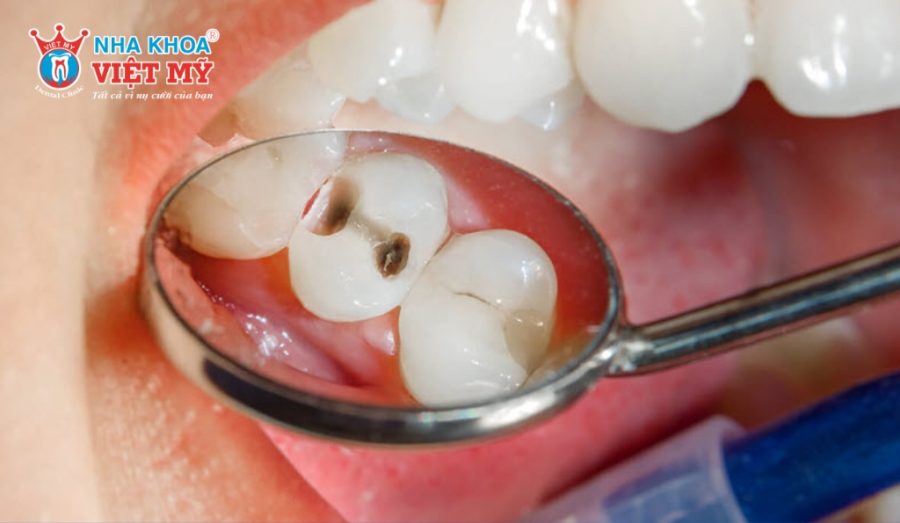 Răng bị sâu nặng lây đến tuỷ là một trong những trường hợp nên lấy tủy ở trẻ