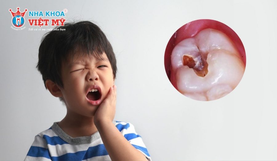 Lấy tủy răng ở trẻ em giúp loại bỏ phần tủy viêm, làm sạch răng và bảo tồn phần răng còn khỏe