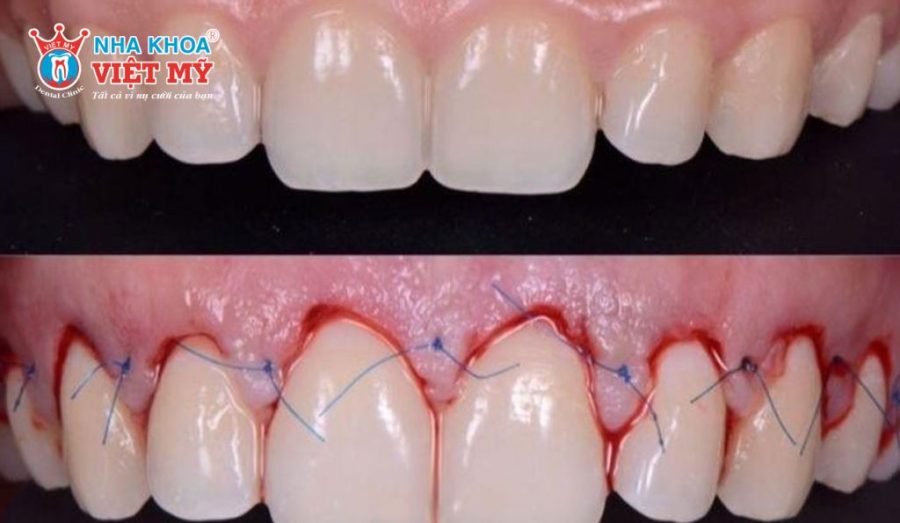 Mài xương ổ răng là kỹ thuật nha khoa tiên tiến