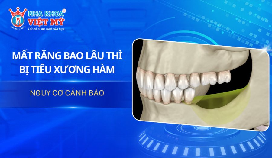 Mất răng bao lâu thì bị tiêu xương hàm là thắc mắc của nhiều người