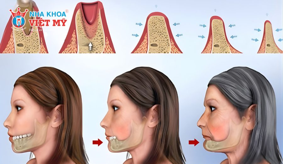 Tiêu xương hàm thường theo dạng dọc, ngang hoặc tiêu xương vùng xoang