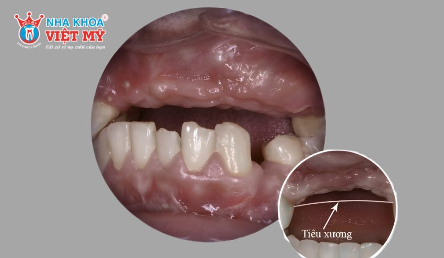 Mất răng bao lâu thì bị tiêu xương hàm và các giải pháp khắc phục