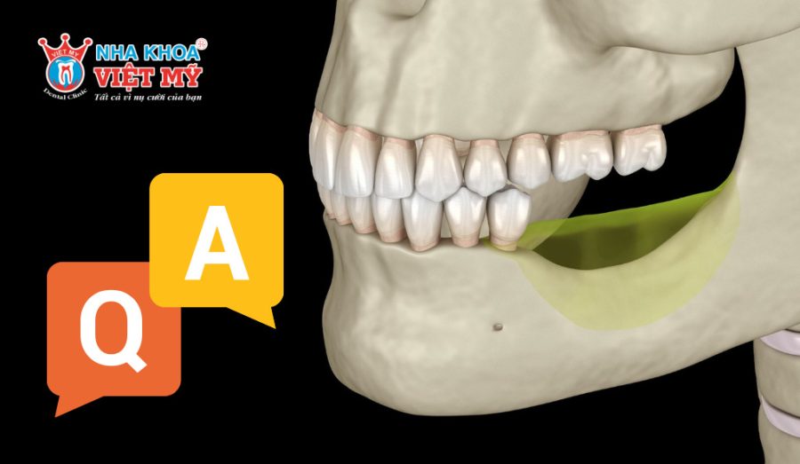 Mấy răng sau 3-4 tháng đã có thể phục hình implant