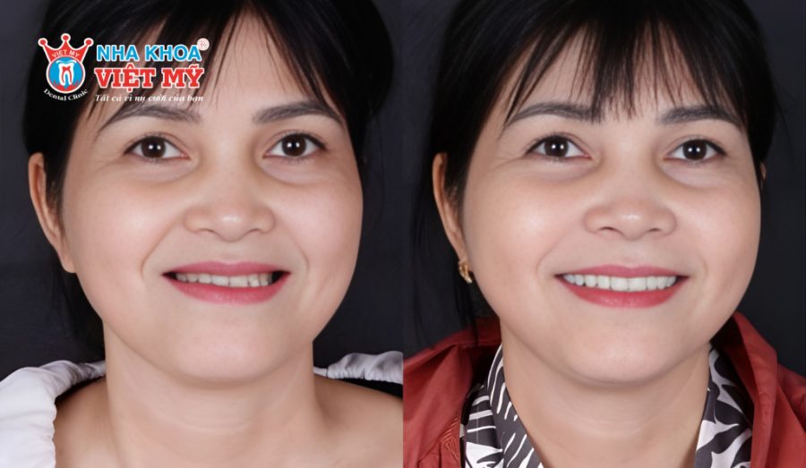 Ngoài trồng răng Implant, bạn có thể chọn phương pháp ghép hoặc nâng xương