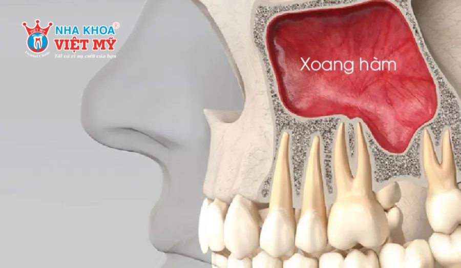 Hậu quả của tình trạng tiêu xương hàm