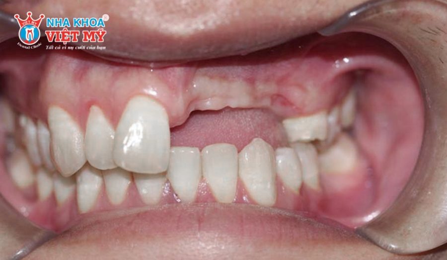 Người lớn tuổi có men răng mỏng và dễ mài mòn, làm tăng nguy cơ mất răng