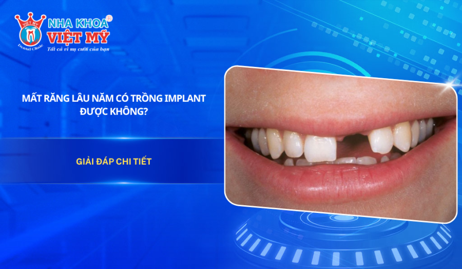 Giải đáp: Mất răng lâu năm có trồng Implant được không?