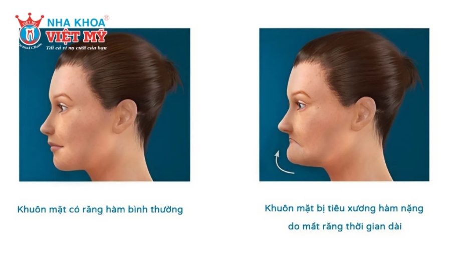 Mất răng lâu năm khiến xương hàm tiêu, nướu tụt, khuôn mặt mất cân đối và nhanh lão hóa