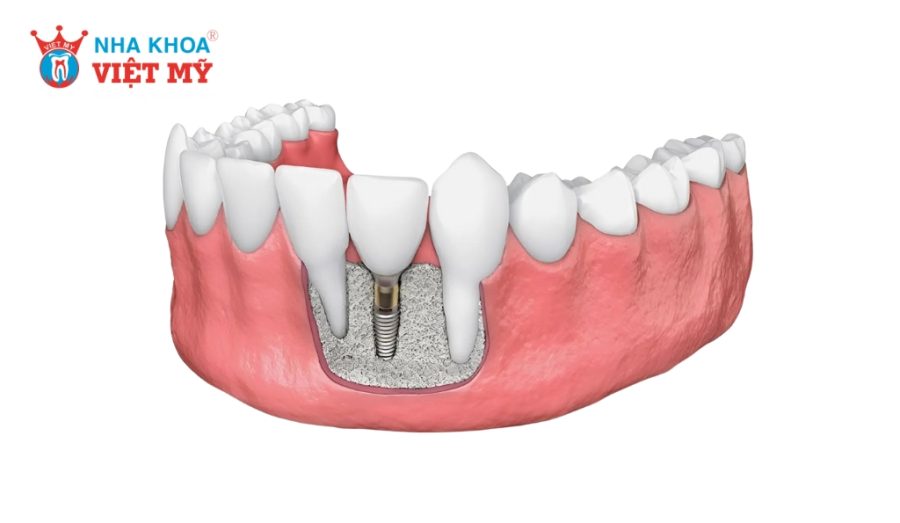 Ghép xương tự thân dùng chính xương của bệnh nhân để bổ sung vào xương hàm để trồng Implant