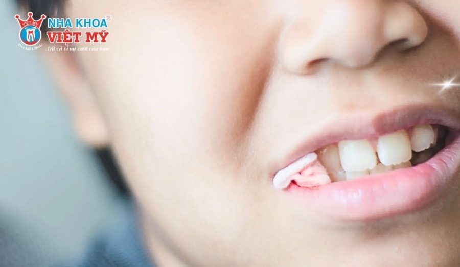 Cần chăm sóc răng miệng đúng cách sau khi nhổ răng khôn mọc thẳng