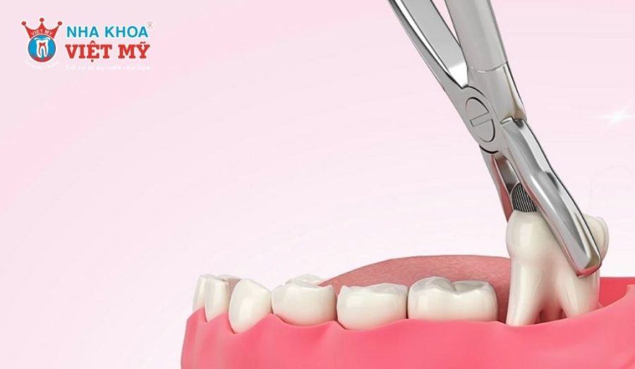 Bác sĩ vẫn khuyến cáo nên nhổ sớm để ngăn ngừa biến chứng về sau