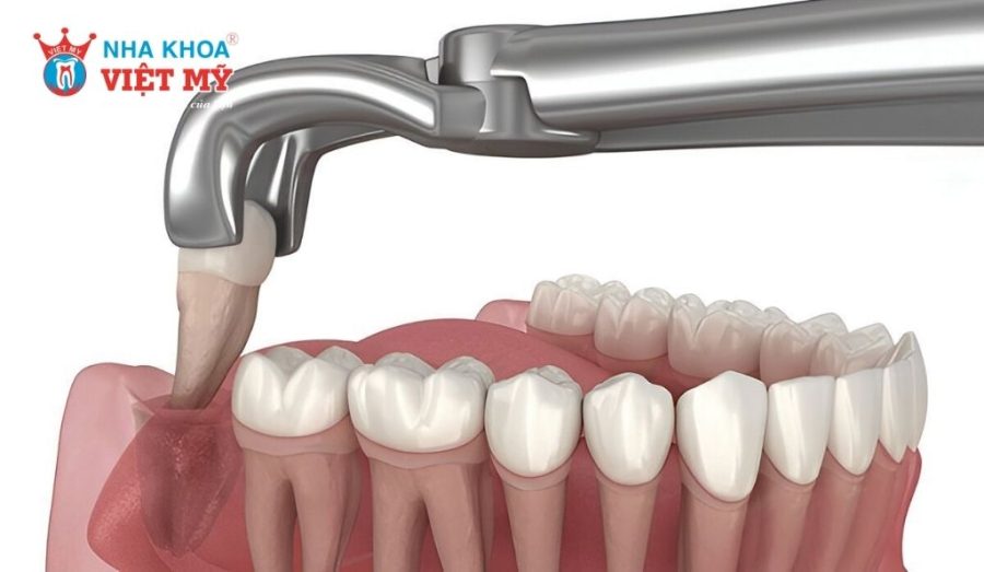 Răng khôn mọc thẳng có bắt buộc phải nhổ bỏ không?