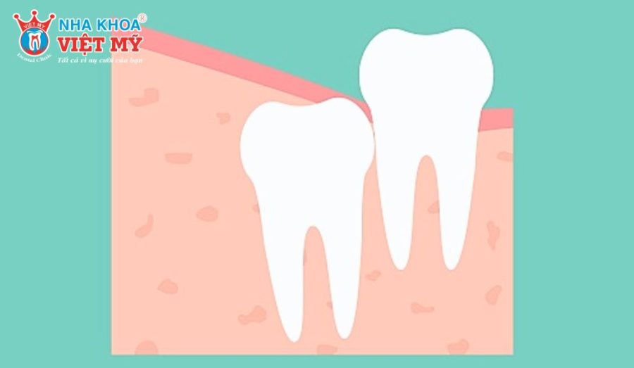 Răng khôn mọc đúng hướng có thể chỉ đau nhẹ trong thời gian đầu