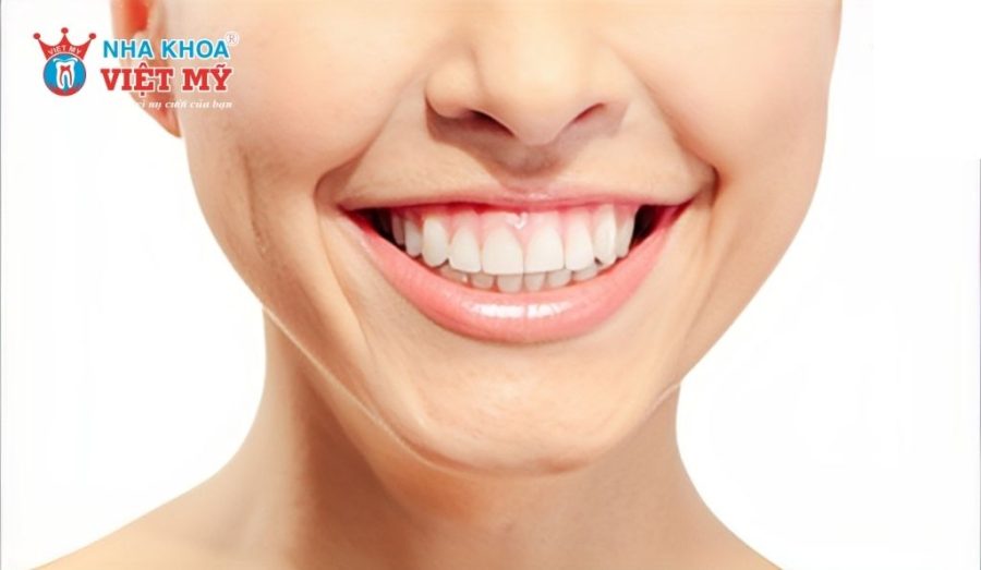 Lộ nướu khi cười là biểu hiện của ca niềng răng không đạt chuẩn