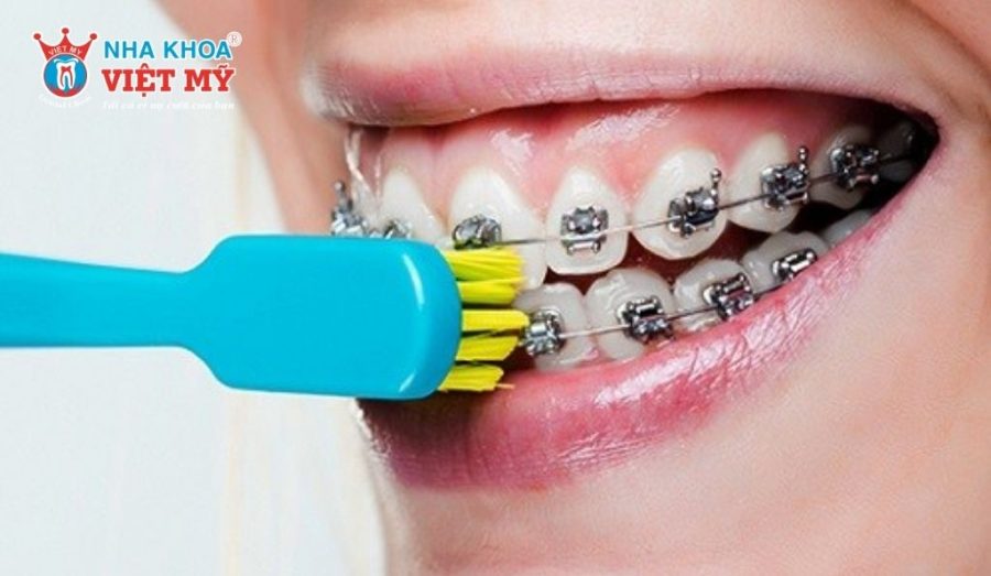 Thói quen chăm sóc răng miệng kém hiệu quả là nguyên nhân khiến kết quả niềng răng không như mong đợi