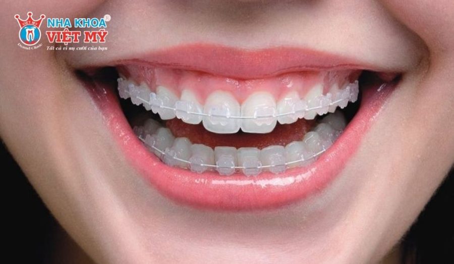 Niềng lại hoặc chỉnh nha bổ sung là cách khắc phục hiệu quả khi tình trạng niềng răng xong vẫn xấu