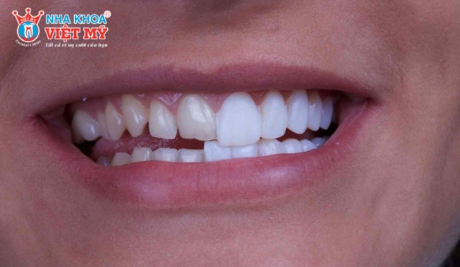 Phôi sứ Zirconia chi phí cao nhưng bền đẹp và an toàn