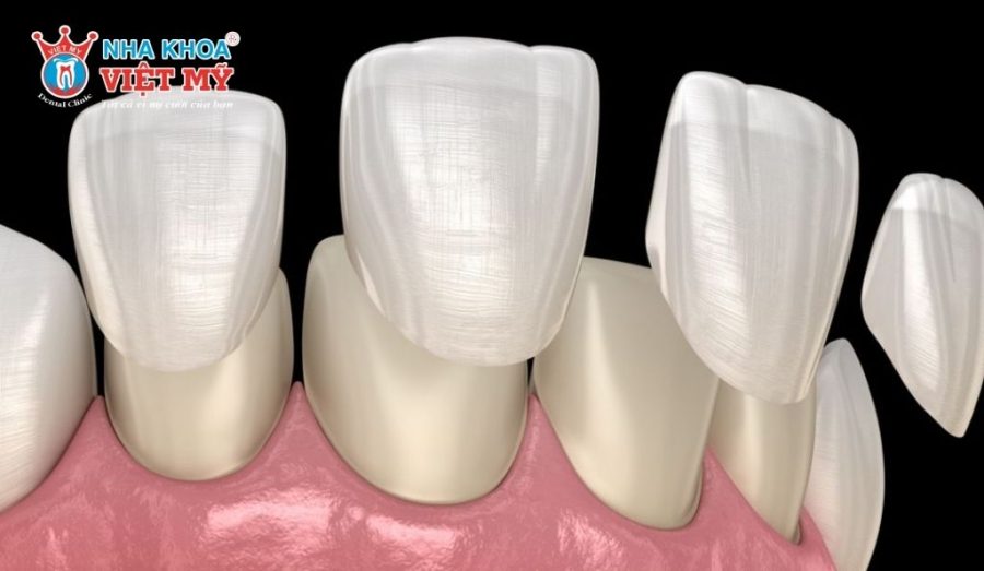 Có thể phục hình răng sâu bằng phương pháp dán sứ Veneer