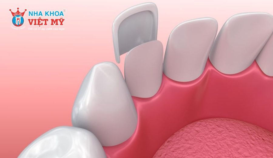 Chi phí dán sứ có thể dao động từ 4 đến 12 triệu đồng cho răng đã bị sâu