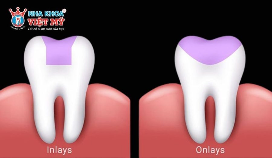 Dán sứ Inlay/Onlay là phương pháp dán sứ phù hợp cho răng đã bị sâu