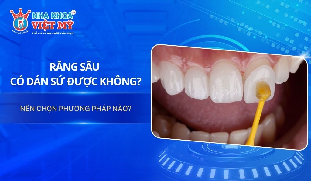 Răng sâu có dán sứ được không? Nên chọn phương pháp nào