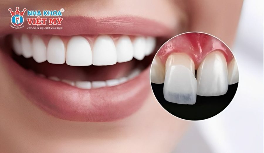 6 ưu điểm nổi bật khi phục hình bằng phương pháp dán sứ trên răng từng bị sâu