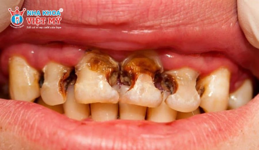 Răng dán sứ có thể bị sâu trở lại bởi nhiều nguyên nhân