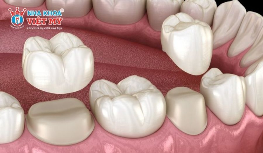 Kỹ thuật thực hiện bọc sứ chưa chuẩn xác là nguyên nhân khiến răng sứ dễ bị sứt