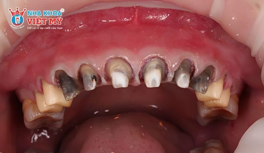 Cùi răng bị sâu hoặc yếu đi là nguyên nhân làm cho răng sứ dễ bị sứt, mẻ