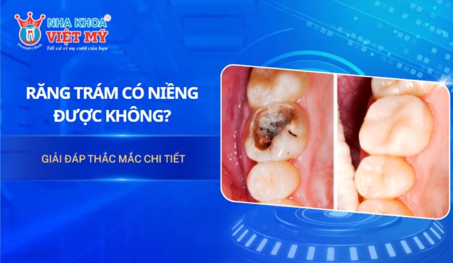 Giải đáp thắc mắc: Răng trám có niềng được không?