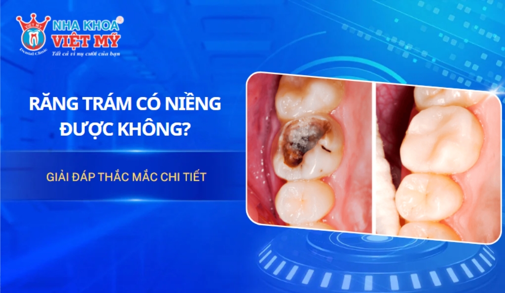 Giải đáp thắc mắc: Răng trám có niềng được không?