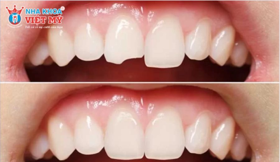 Trám răng giúp phục hồi răng hư tổn