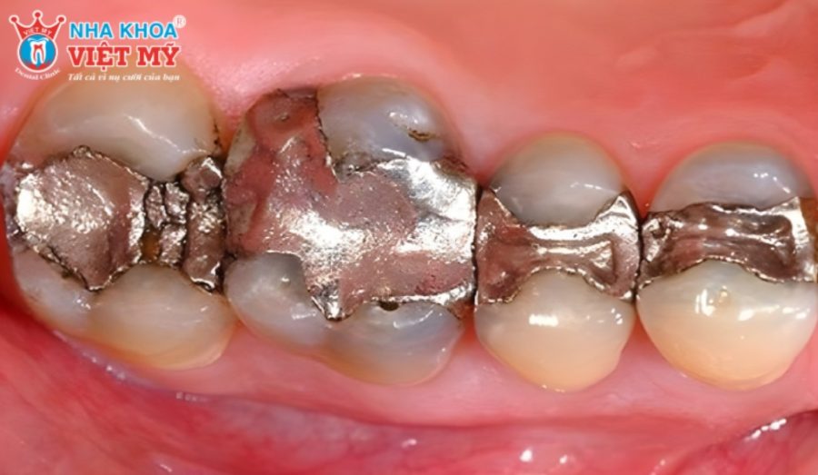 Để răng sử dụng được thời gian dài nên sử dụng các vật liệu trám có chất lượng tốt