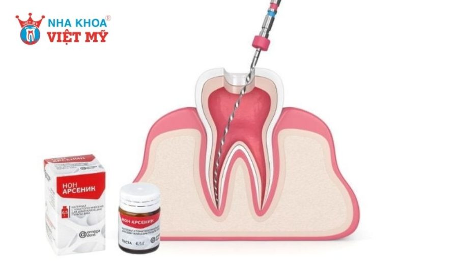 Quy trình đặt thuốc diệt tủy được thực hiện tuần tự theo 3 bước cơ bản