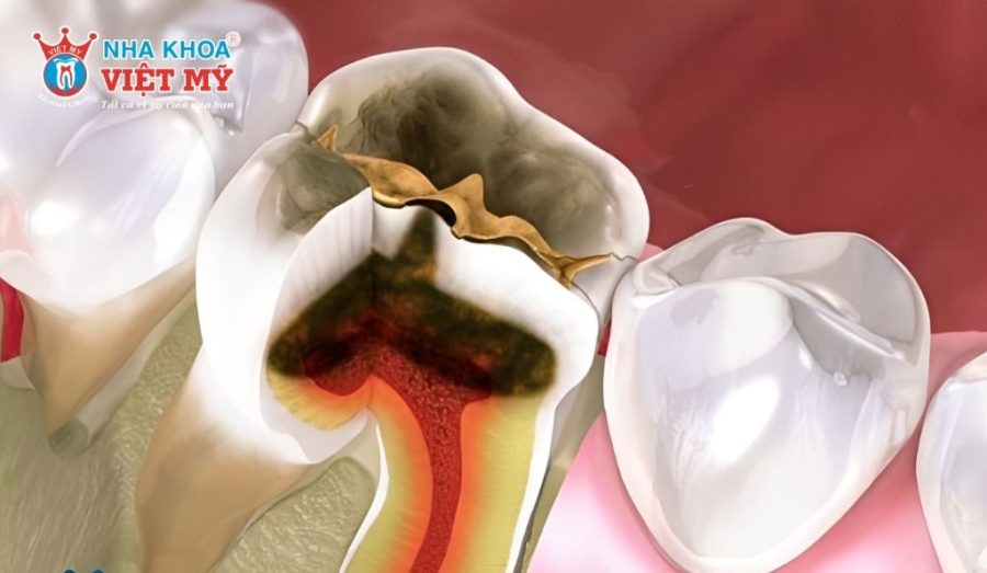 Thuốc diệt tủy răng là gì?