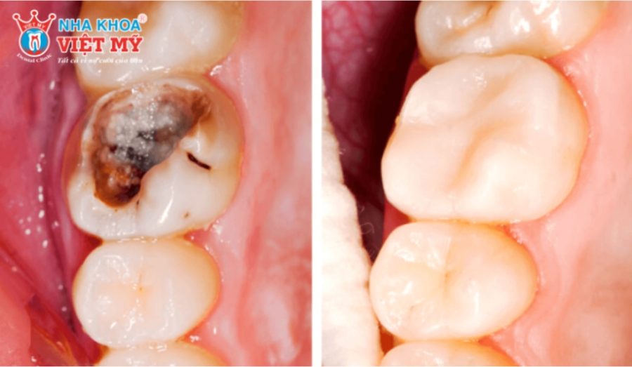 Răng nào có thể trám được bằng Composite