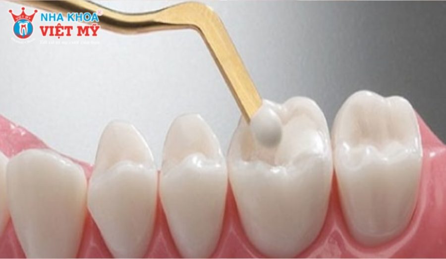 Các bước trám răng Composite