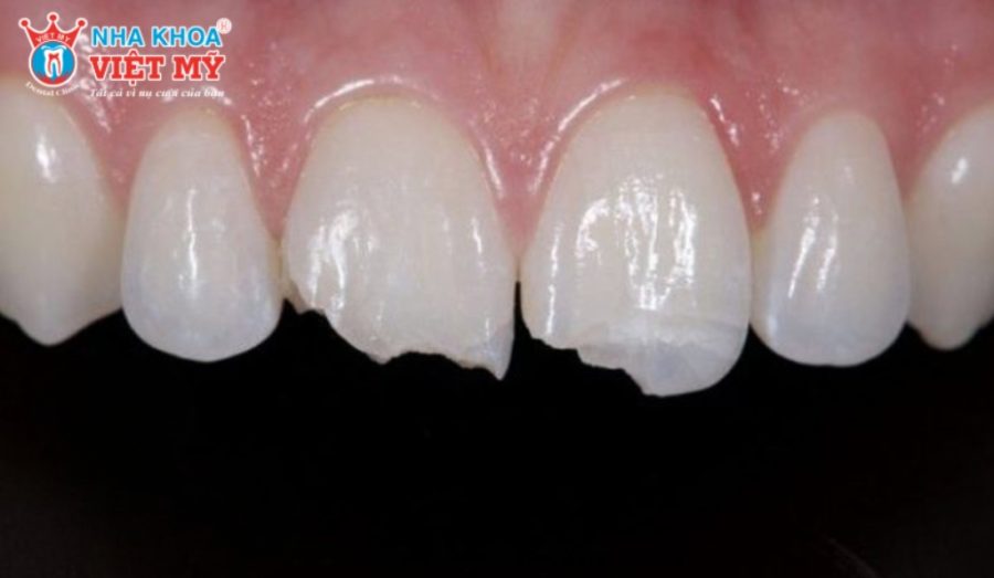 Trám răng bằng Composite vào răng cửa hoặc răng nanh