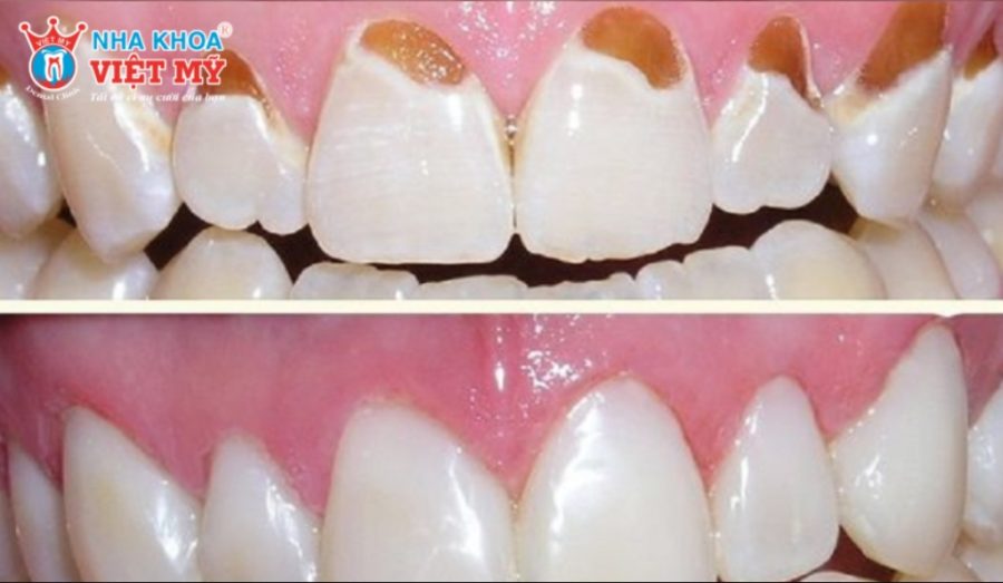 Ưu điểm và nhược điểm khi trám răng bằng Composite