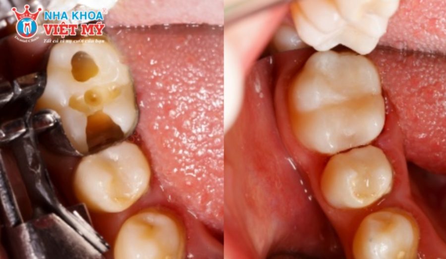 Trám răng bằng Composite phục hình răng hư tổn