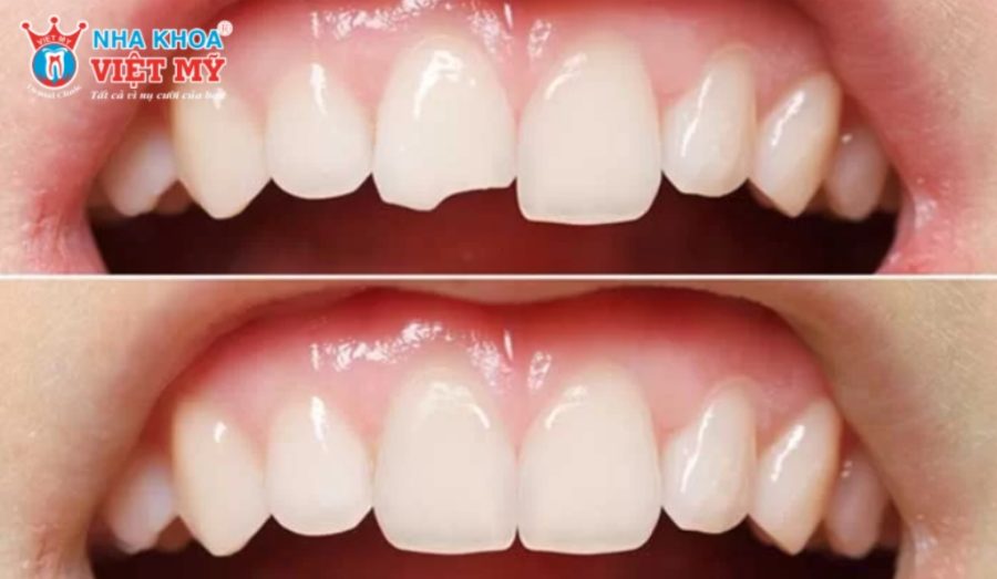 Chi phí trám răng Composite