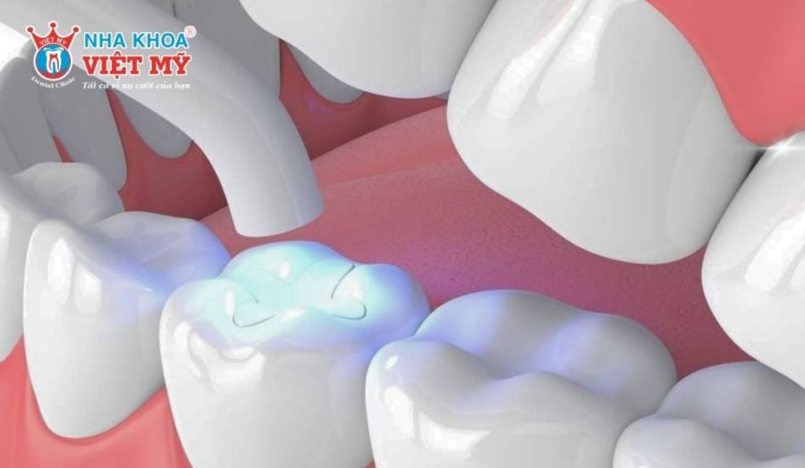 Giá trám răng cửa tùy theo vật liệu bạn lựa chọn