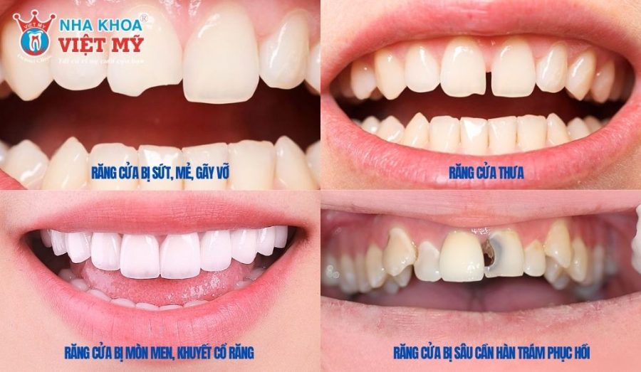 Khi nào răng cửa cần phải được trám?