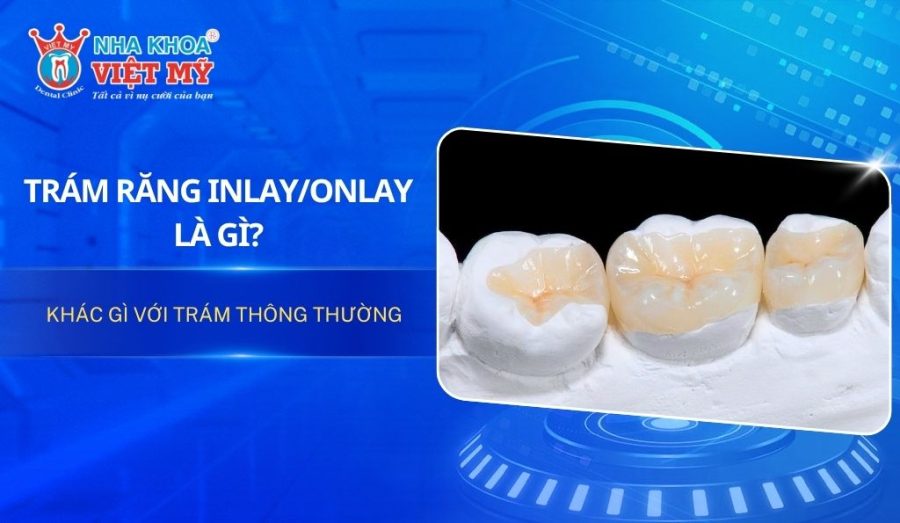Trám răng Inlay/Onlay là gì? Khác gì với trám thông thường