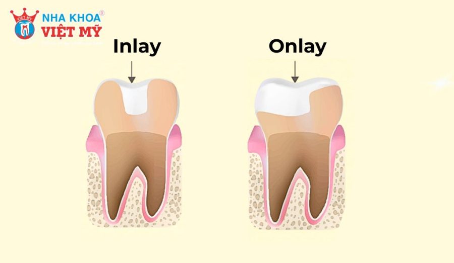 Inlay và Onlay là kỹ thuật phục hình răng hiện đại