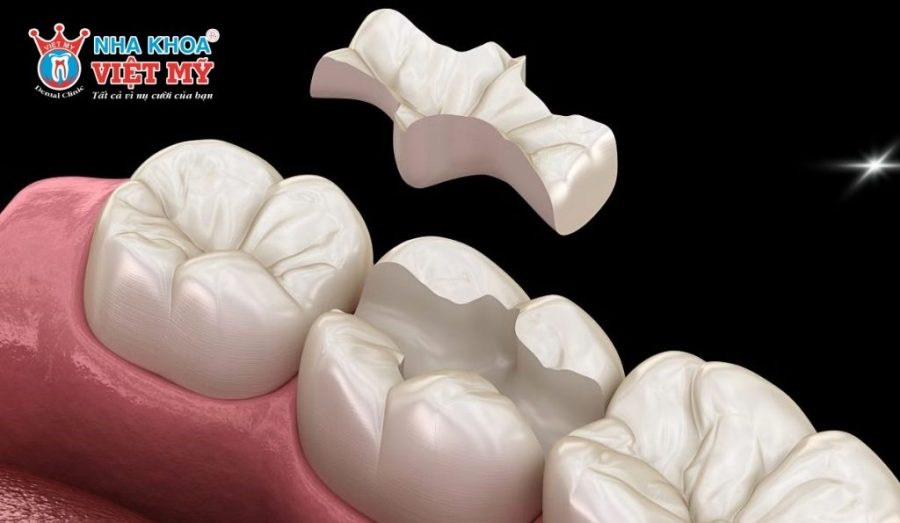 Trám răng Inlay/Onlay được đánh giá cao nhờ độ bền vượt trội