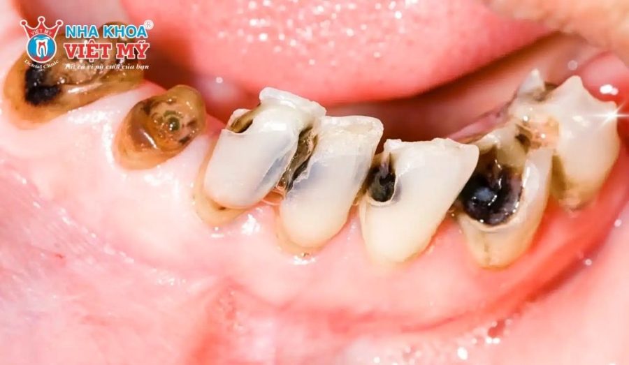 Răng tổn thương nặng cần phục hình chuyên sâu hơn