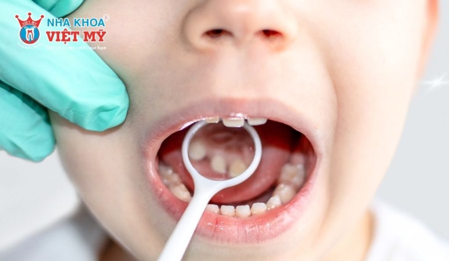 Răng sữa của trẻ bị sâu cần được can thiệp kịp thời