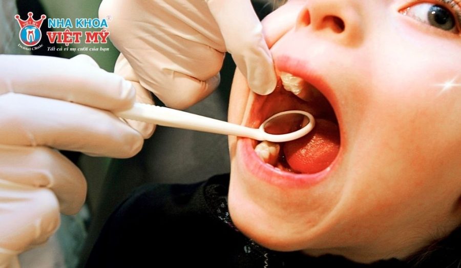 Có hai phương pháp lựa chọn khi trám răng sữa cho bé