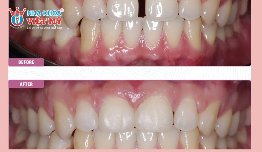 Vết trám răng thưa thường giữ được trung bình từ 4 đến 8 năm